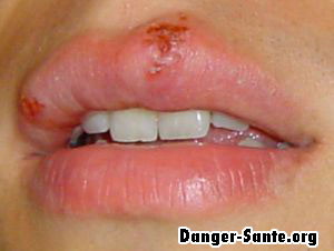 comment soigner herpes a la bouche