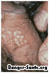 Herpes sur le penis chez l'homme