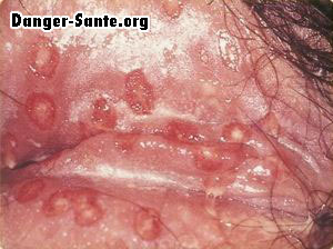 Photo herpes sur le Vagin chez la femme