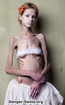 image top model anorexique