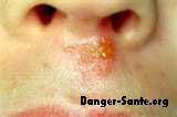 photos herpes sur le nez